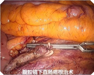 腹腔鏡下直腸癌無熒光效果 腹腔鏡下直腸癌無熒光效果